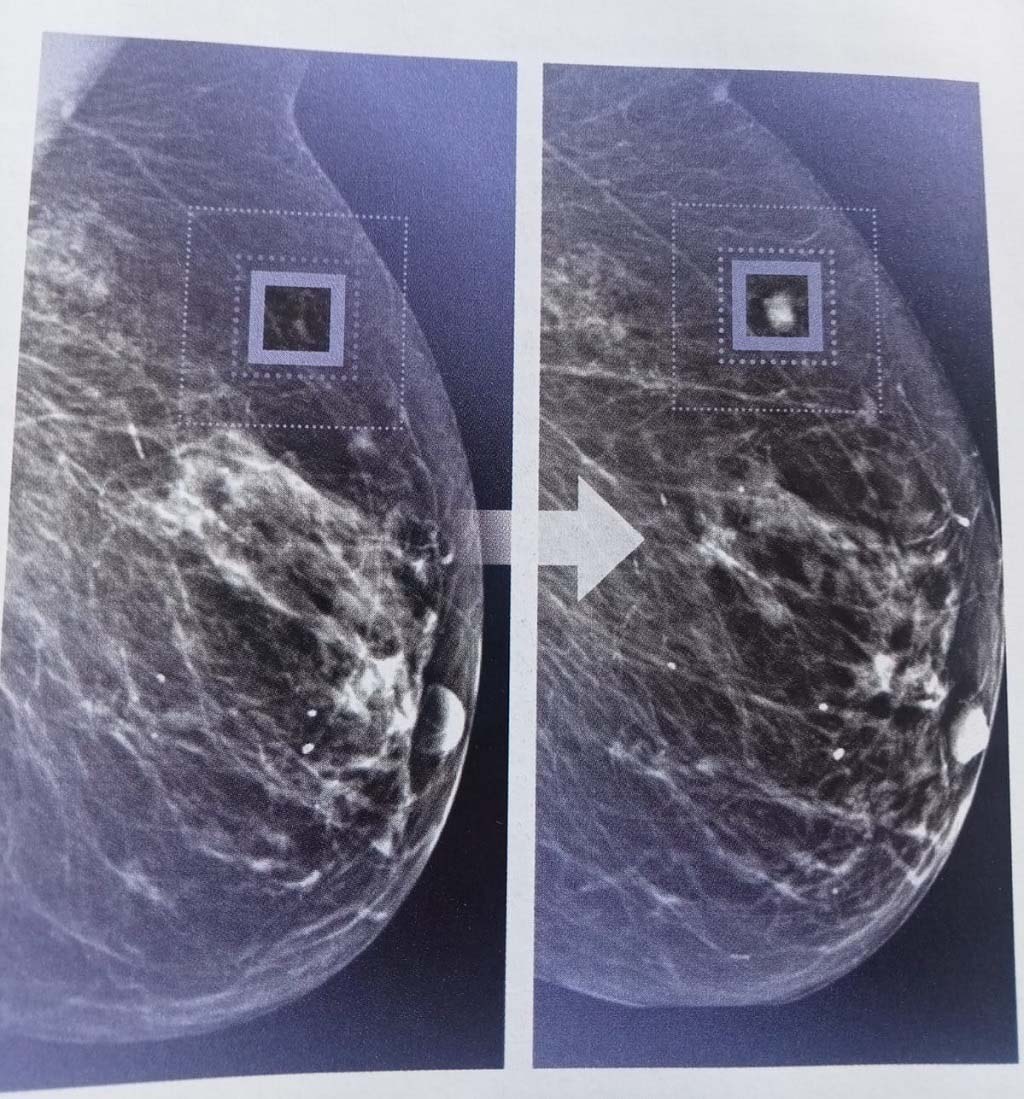 AI Cancer radiologieopera 26022024 02