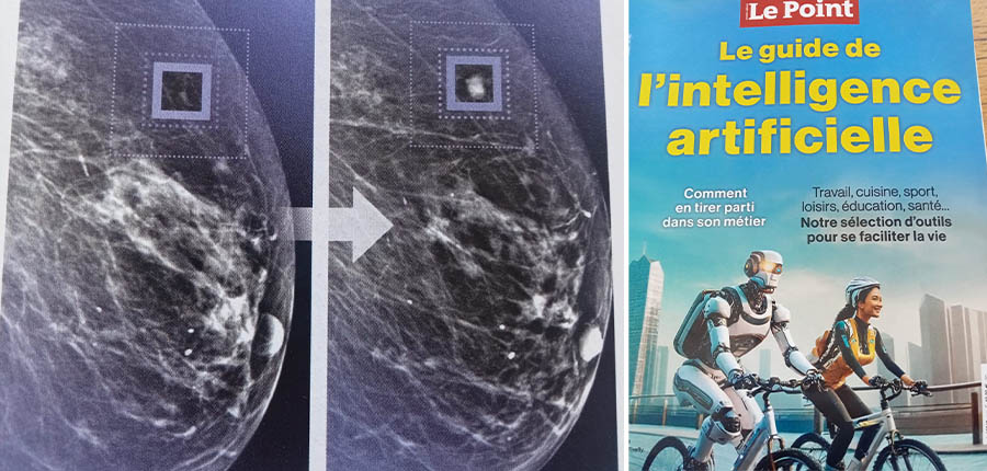 Un algorithme identifie un cancer du sein quatre ans avant qu’il ne soit visible