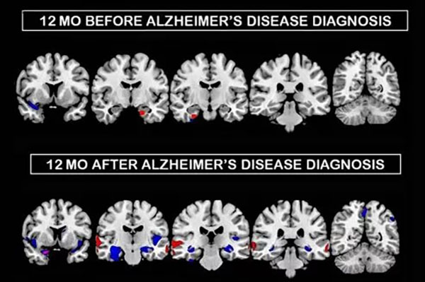 IRM maladie Alzheimer 19052022