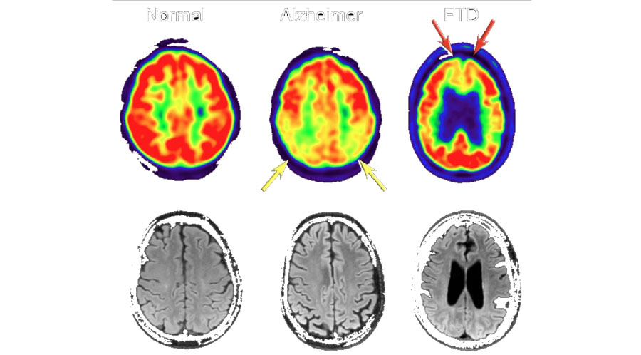 Place de l’IRM pour prédire l’évolution de la maladie d’Alzheimer