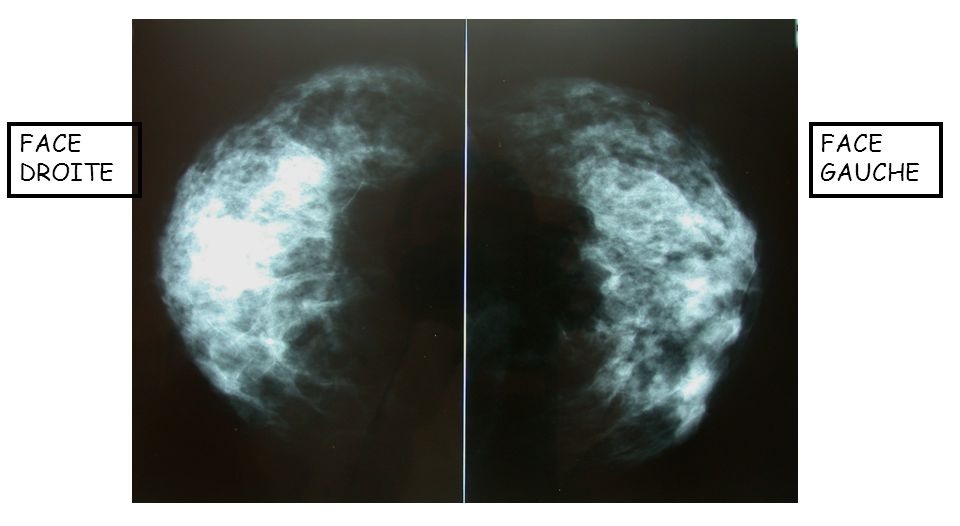 MAMMOGRAPHIE27022018 1819