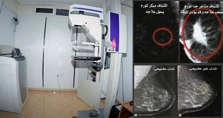 Mammographie 31072017