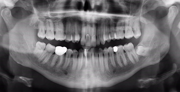 Panoramique dentaire clichet01