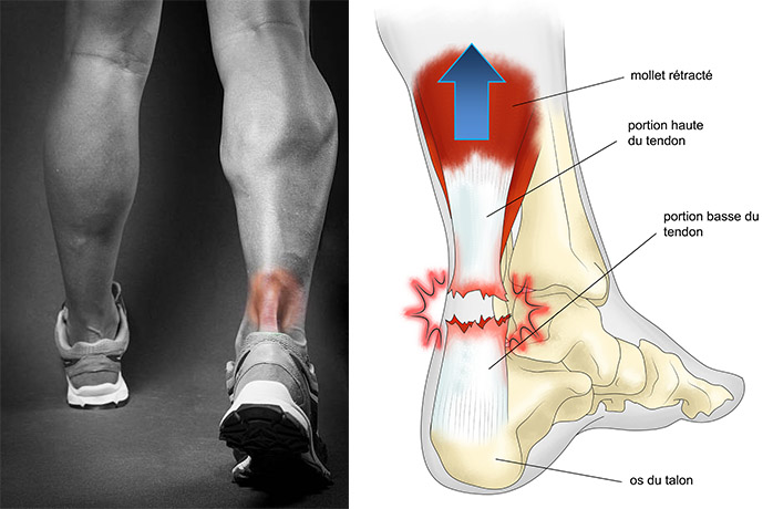 Rupture du tendon d’Achille chez le footballeur: Rôle de L’IRM