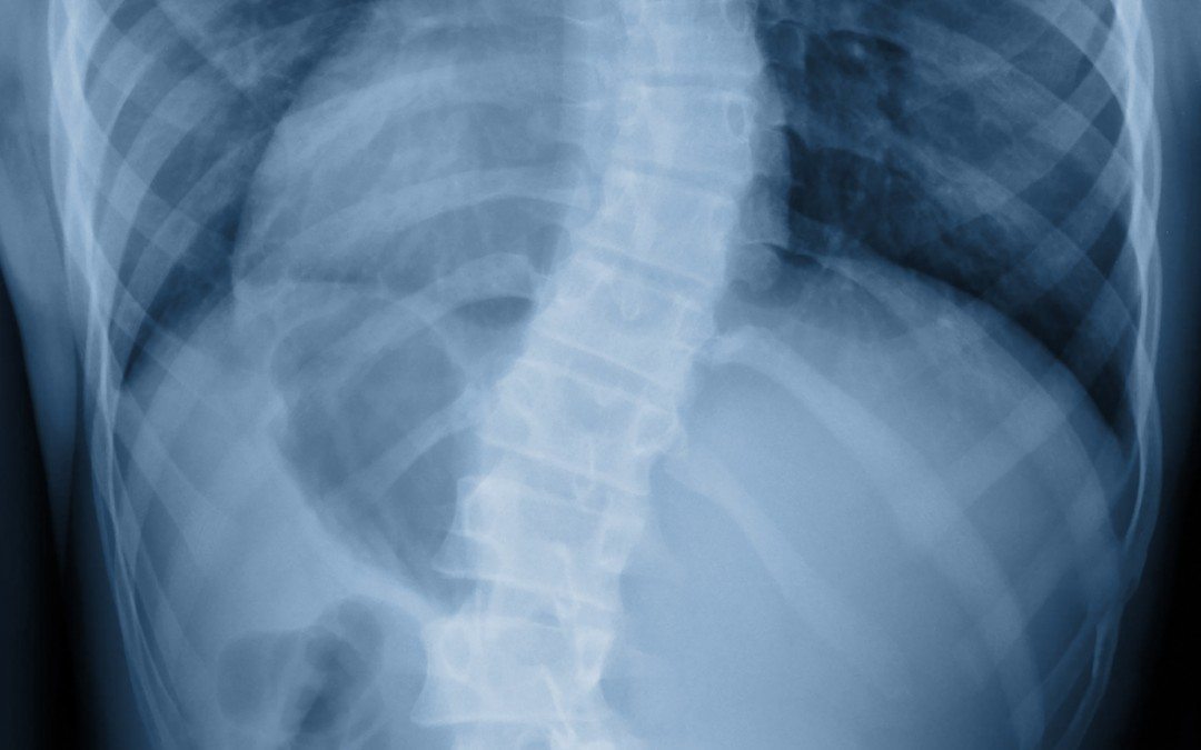 Scoliose de ladolescent 18052018