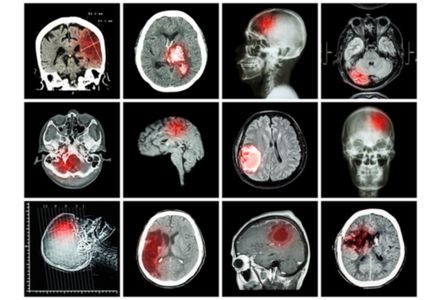 alzheimer