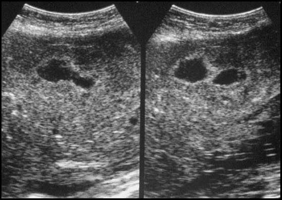 cancer de lendometre 001