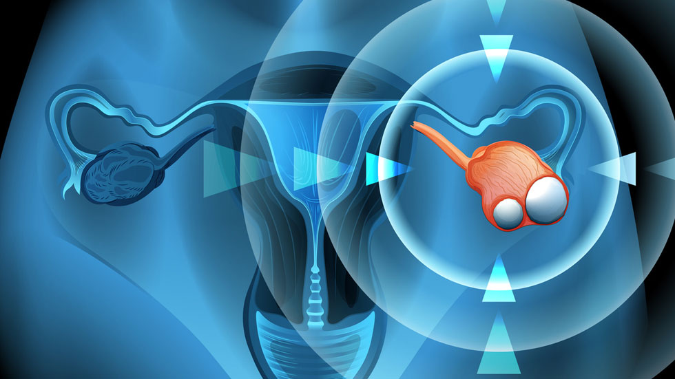 cancer de lovaire001