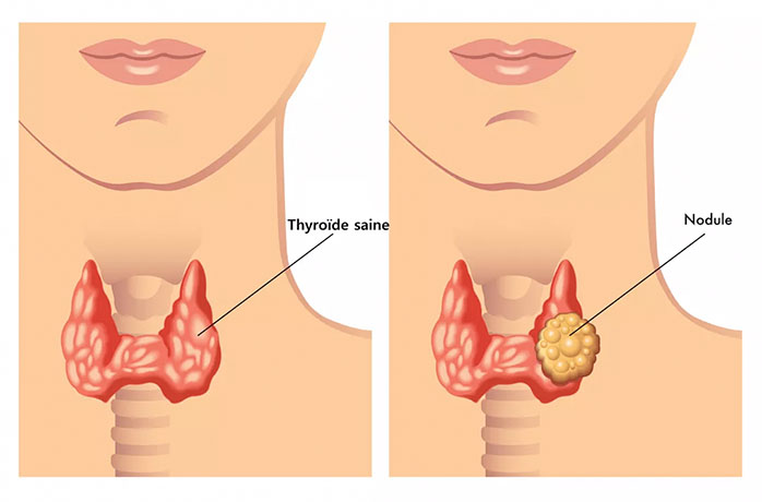echographie glande thyroide 09062022
