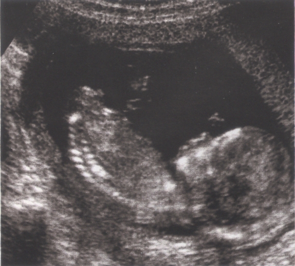 echographieFoetusIMG1