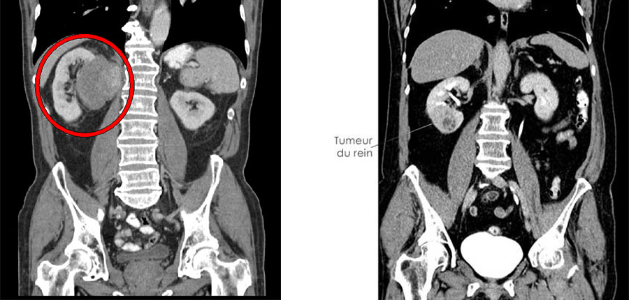 Grâce à l’imagerie précoce, le cancer du rein se guérit