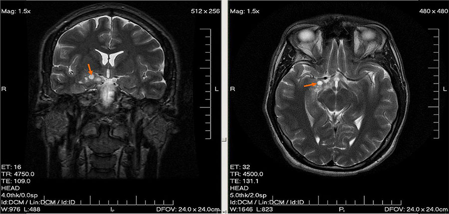 La découverte fortuite d’une tumeur cérébrale grâce à l’imagerie médicale